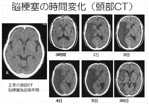 脳梗塞の時間変化(頭部CT)
