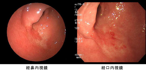 経鼻内視鏡検査で発見した早期胃がん症例